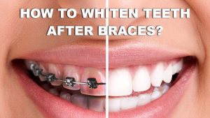 teeth whitening after braces