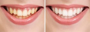 teeth whitening before and after